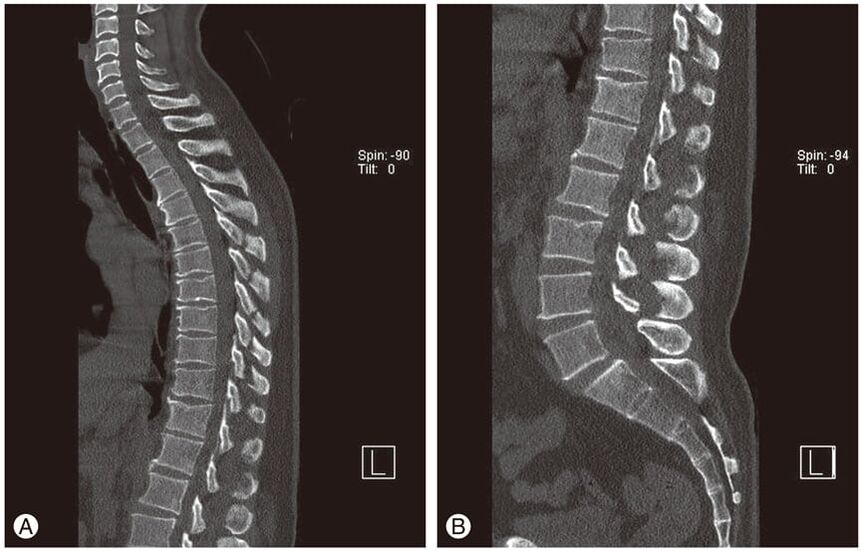 Deformacija medvretenčnih ploščic na slikah MRI pri torakalni osteohondrozi