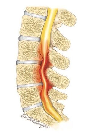 Pri osteohondrozi torakalne hrbtenice pride do stiskanja hrbteničnega kanala