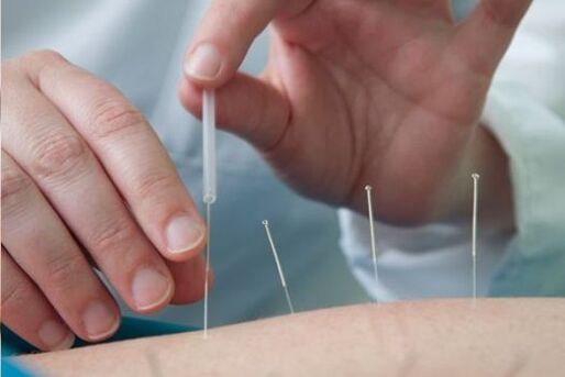 Akupunktura - metoda zdravljenja bolečine v ledvenem delu, ki jo povzroča osteohondroza