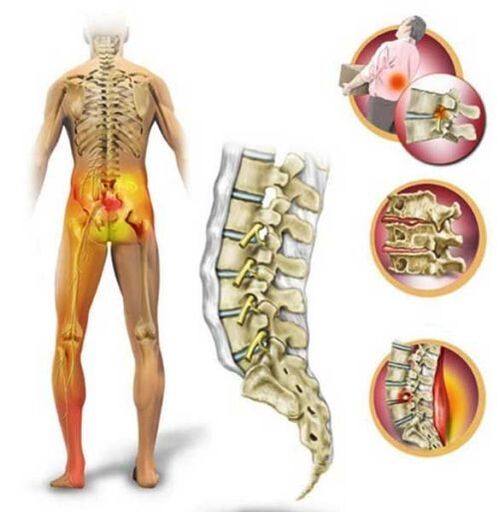 Osteohondroza ledvene hrbtenice, ki povzroča bolečine v hrbtu