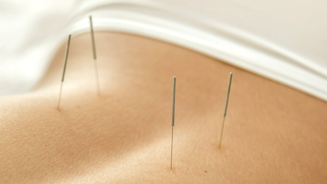 Akupunktura bo pomagala znebiti bolečine v spodnjem delu hrbta